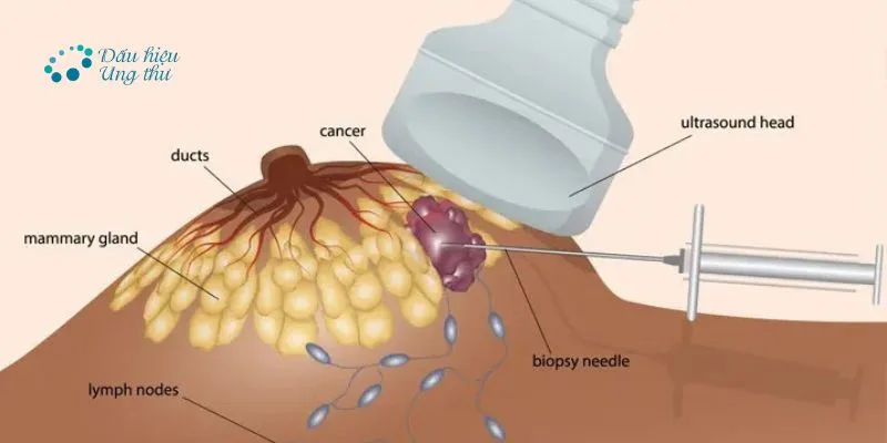 Bị đau ngực ở nữ 